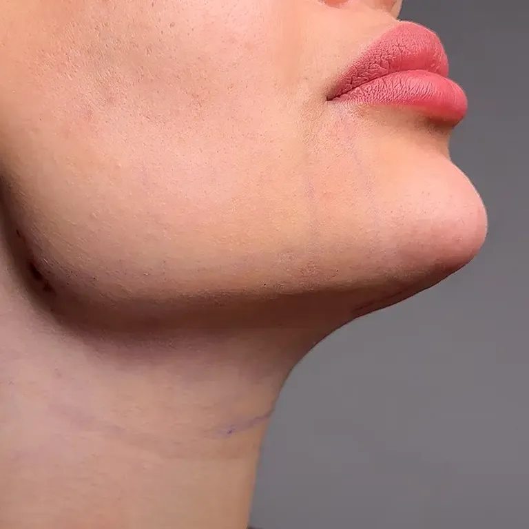v-line_lipo